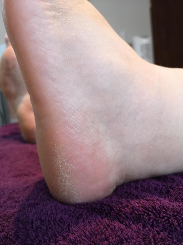 look before Pedicure treatment
