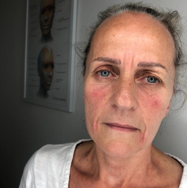 after Facial Fillers treatment