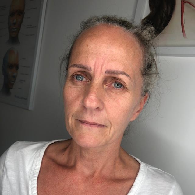 before Facial Fillers treatment
