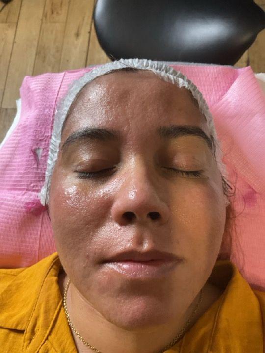 after Skin Lightening treatment