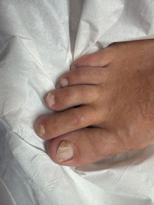 after Fungal Nail Treatment