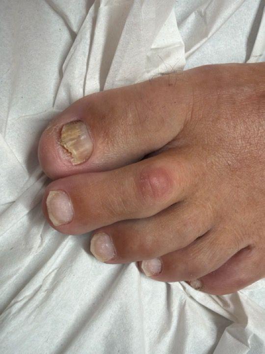 look after Fungal Nail Treatment treatment