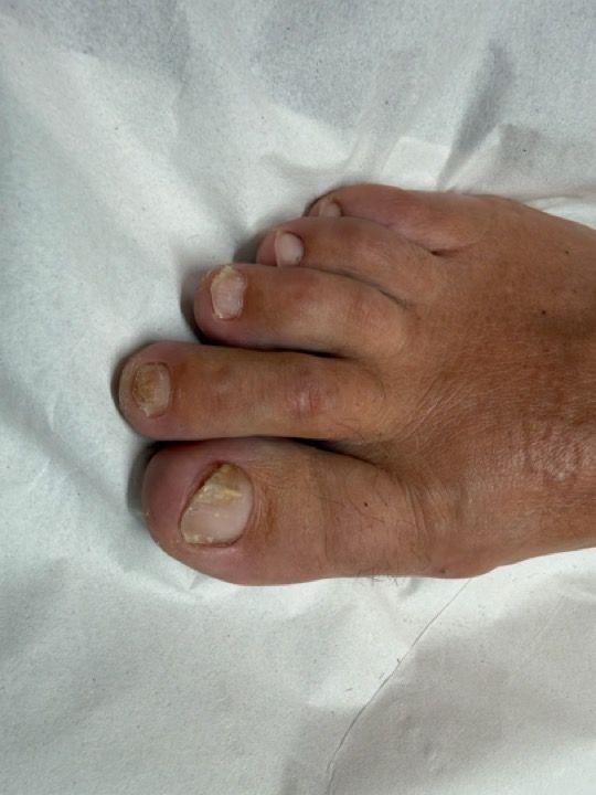 look before Fungal Nail Treatment treatment