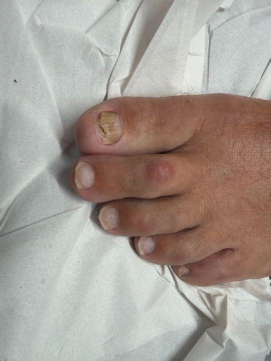 before Fungal Nail Treatment