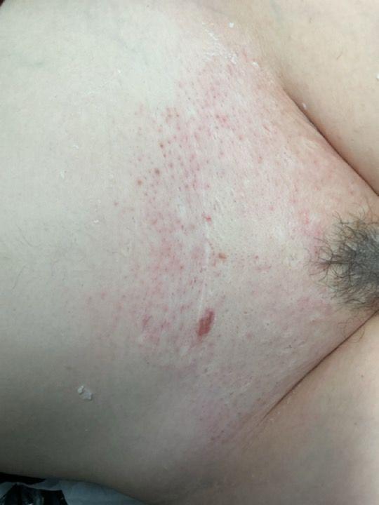 after Bikini Wax treatment