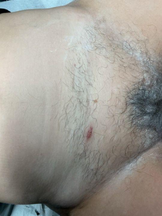 before Bikini Wax treatment