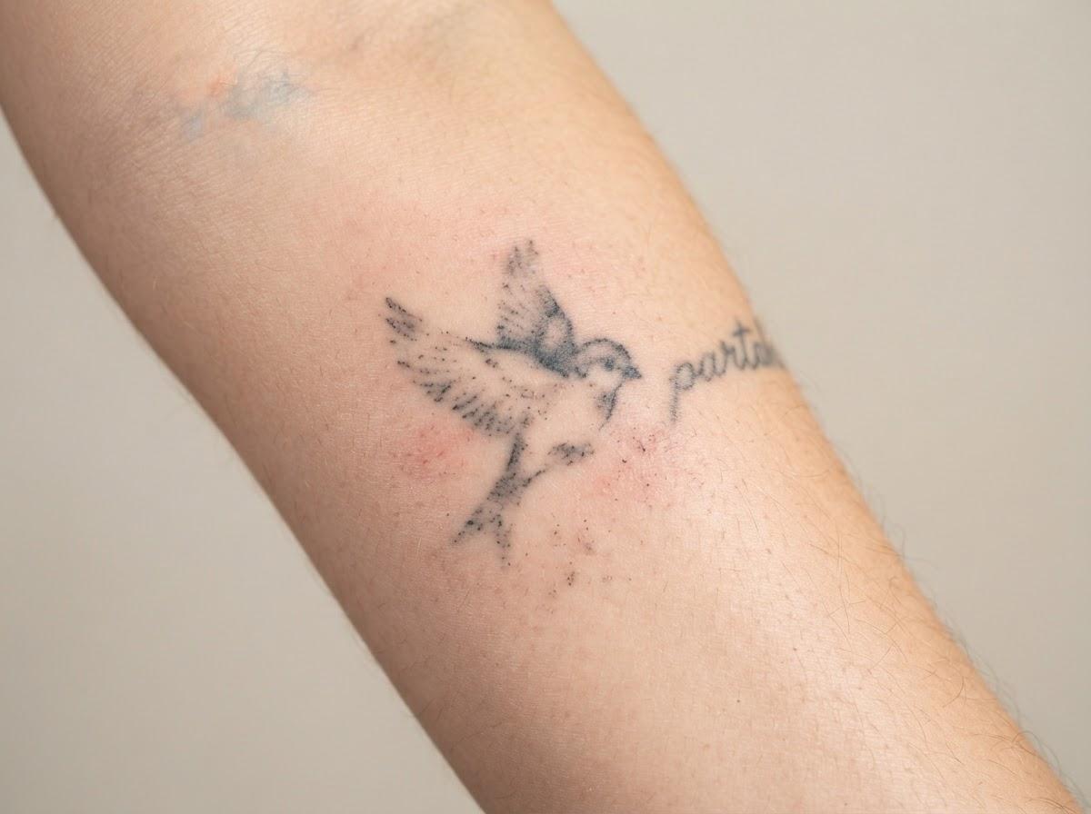 Best Laser Tattoo Removal in London