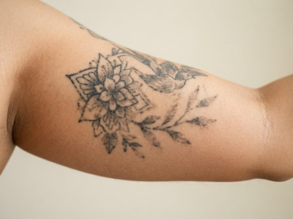Best Laser Tattoo Removal in Birmingham