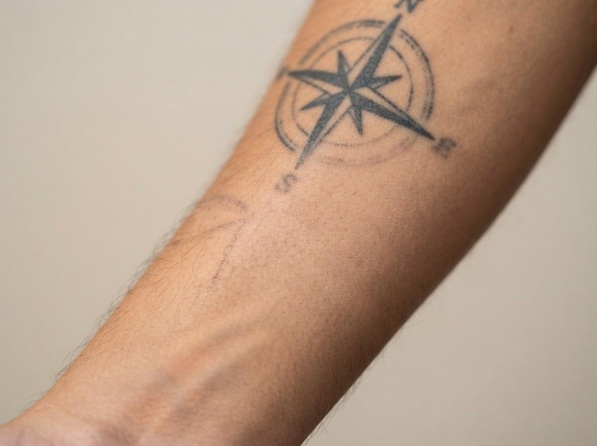 Best Laser Tattoo Removal in Manchester