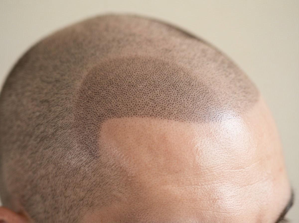 Best Micro Pigmentation in London