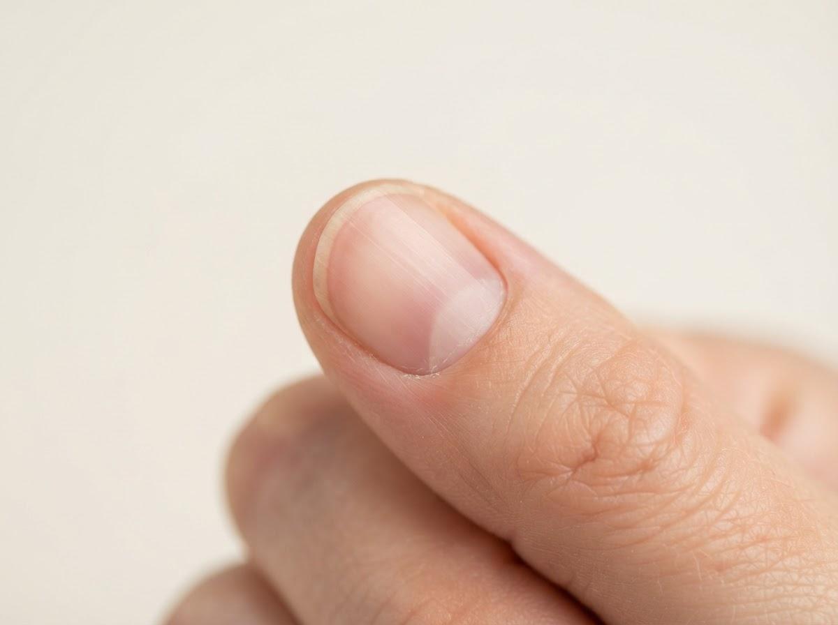 Best Fungal Nail Treatment in Manchester