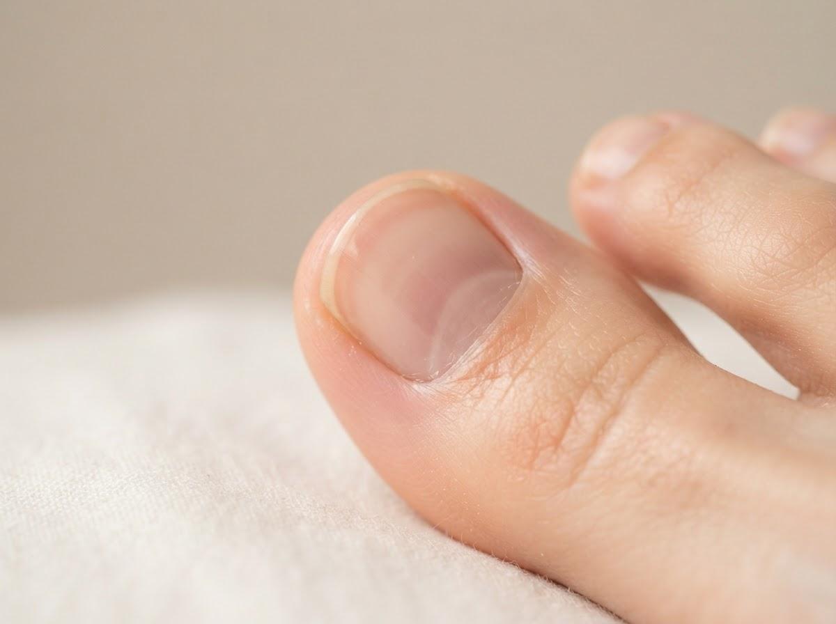 Best Fungal Nail Treatment in Liverpool