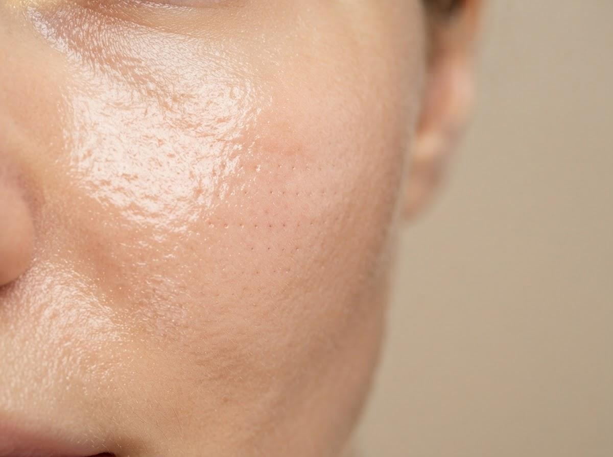 Best Mesotherapy in Manchester