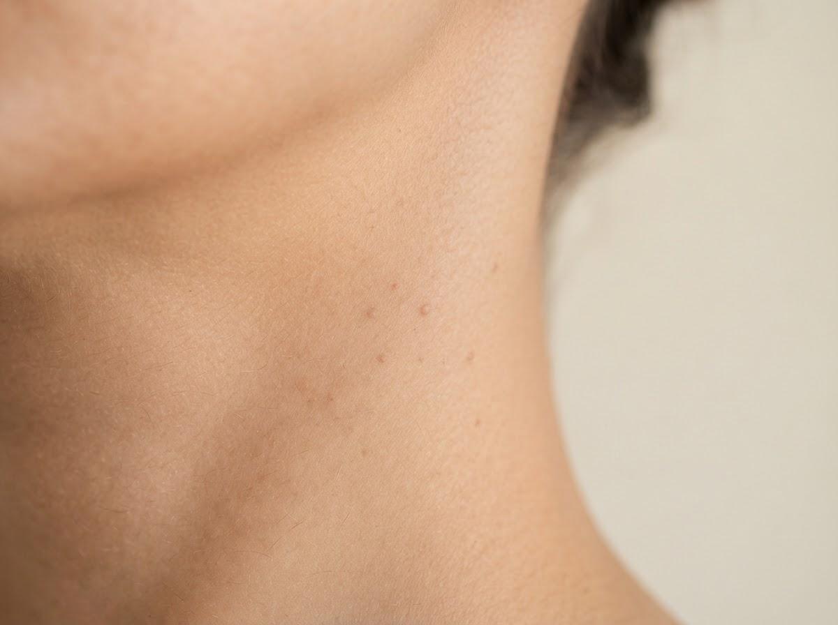 Best Skin Tag Removal in London