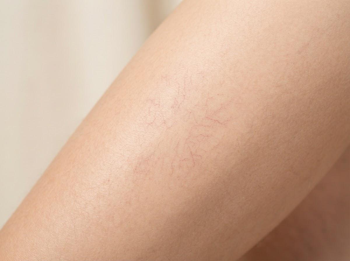 Best Thread Vein Removal in Glasgow